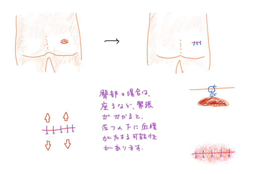 臀部 おしり の粉瘤 福岡市のふじもとクリニック